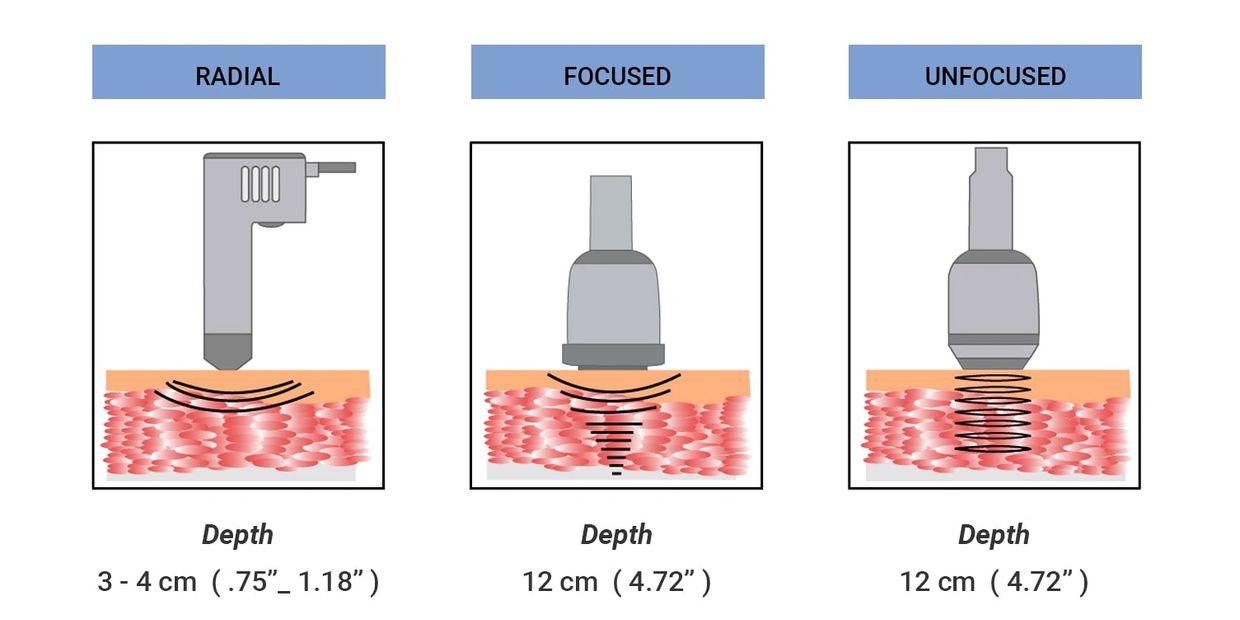 Acoustic Wave Therapy Radial Shockwave Therapy, Shock Wave Therapy